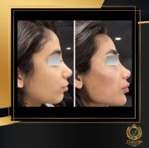 نمونه کار زاویه سازی صورت با دکتر امید