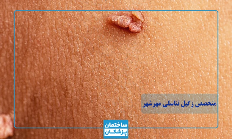 بهترین متخصص زگیل تناسلی در مهرشهر کیست