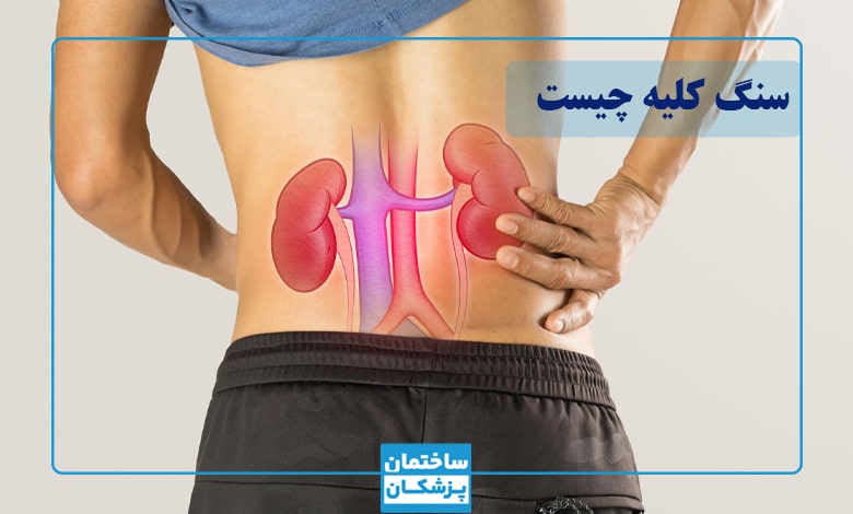 سنگ کلیه چیست؟