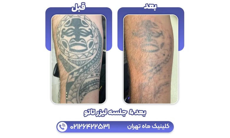 عکس قبل و بعد پاک کردن تاتو بعد از 4 ماه در کلینیک ماه تهران