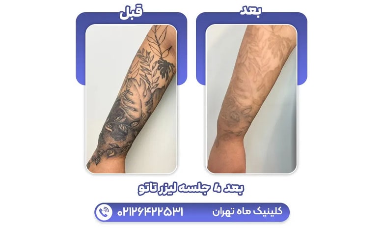 نمونه کار پاک کردن تاتو با لیزر بعد از 4 ماه در کلینیک ماه تهران