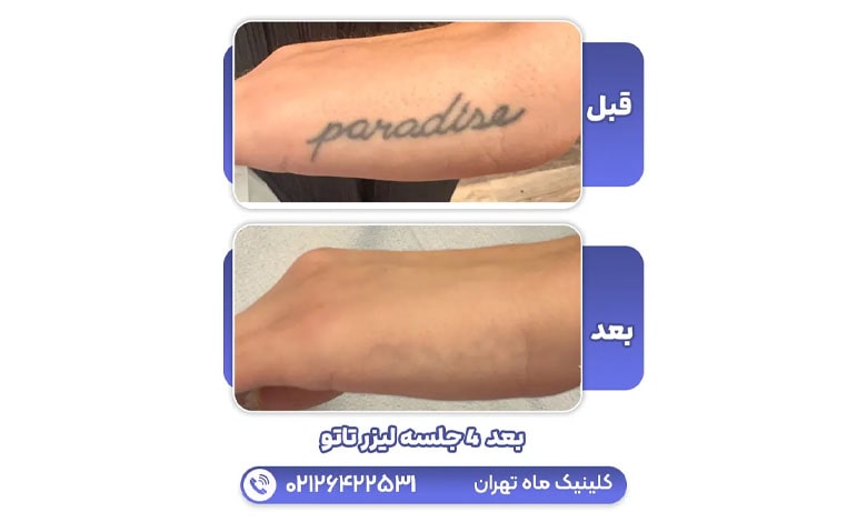 پاک کردن تاتو بعد از 4 جلسه در کلینیک ماه تهران