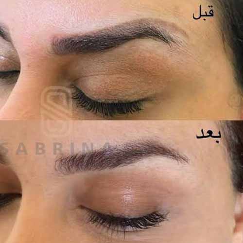 قبل و بعد پاک کردن تاتو ابرو با لیزر در سابرینا