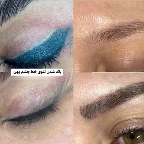 پاک کردن خط چشم پهن با لیزر در سابرینا