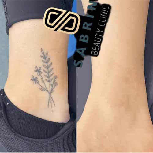 پاک کردن تاتو بدن با لیزر در سابرینا