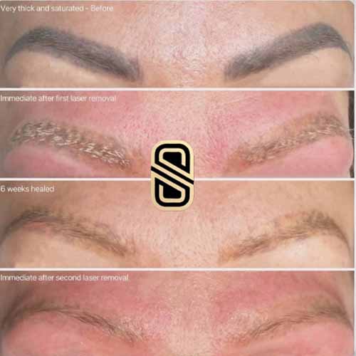 پاک کردن تاتو ابرو مرحله به مرحله در سابرینا
