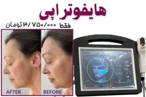 نمونه کار هایفوتراپی مرکز پرتو