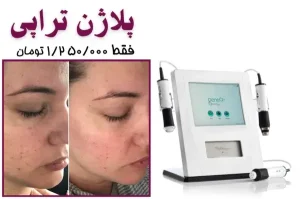 نمونه کار پلاژن تراپی در مرکز پرتو