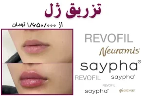 تزریق ژل در کلینیک زیبایی پرتو