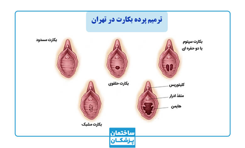 چه عواملی باعث پارگی پرده بکارت میشود؟