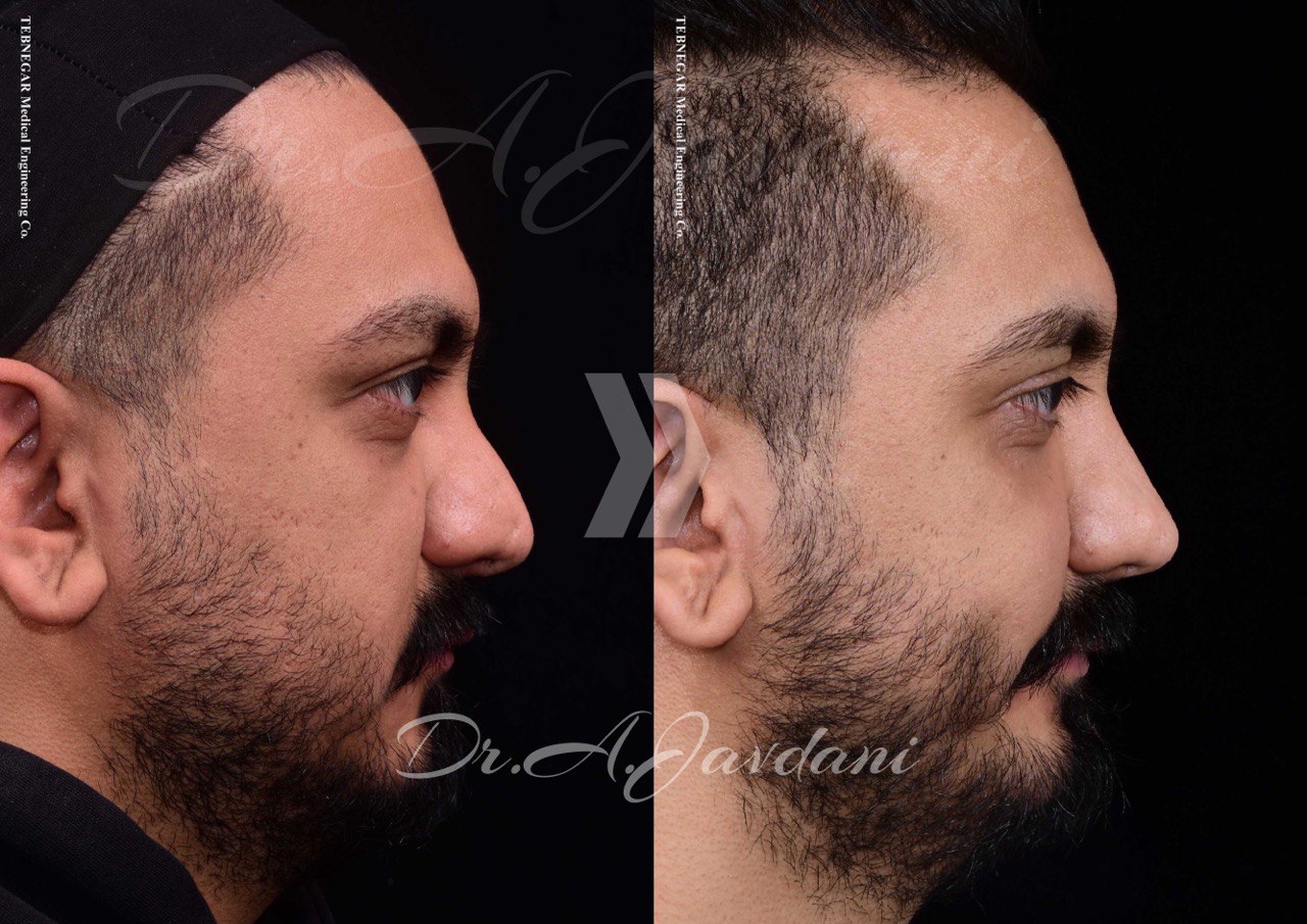 نمونه کار بینی ترمیمی دکتر علی جاودانی