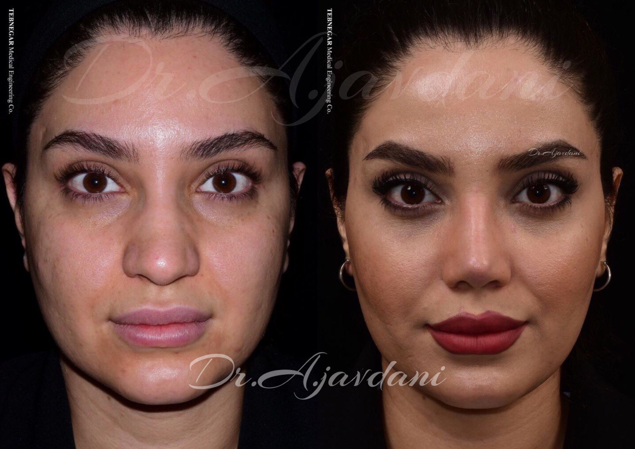 نمونه کار بینی طبیعی دکتر علی جاودانی