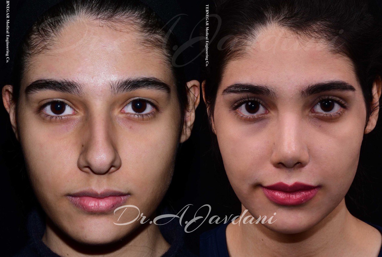 نمونه کار بینی طبیعی دکتر علی جاودانی 3