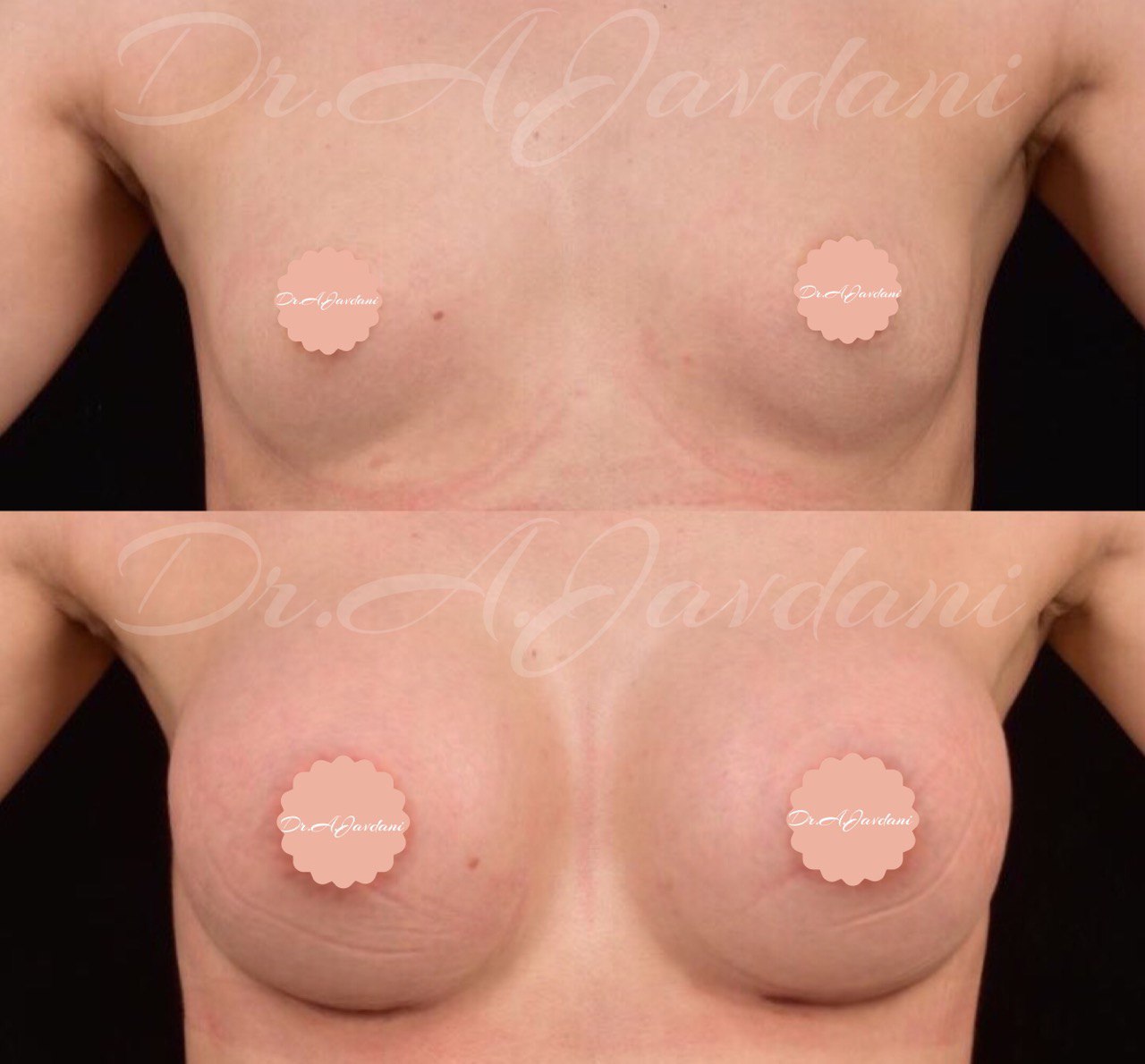 نمونه کار پروتز سینه دکتر علی جاودانی 2