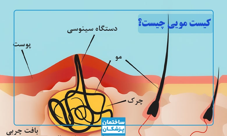 کیست مویی