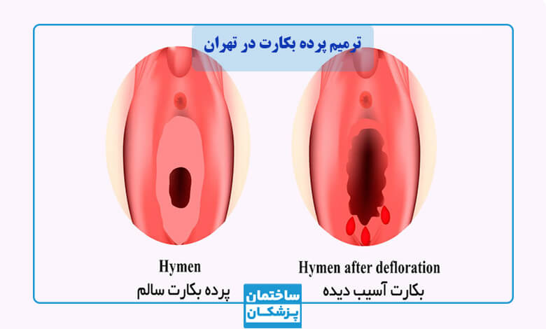 تفاوت پرده بکارت سالم و آسیب دیده