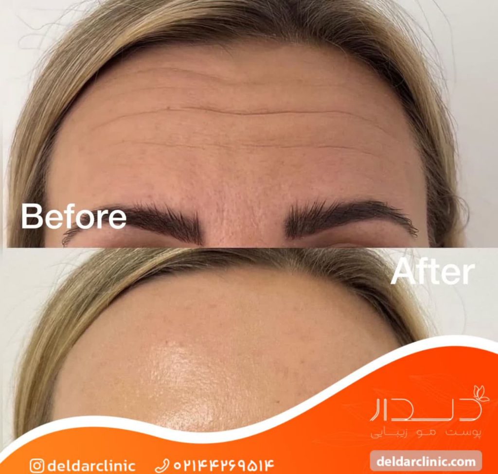 نمونه کار بوتاکس پیشانی در دلدار