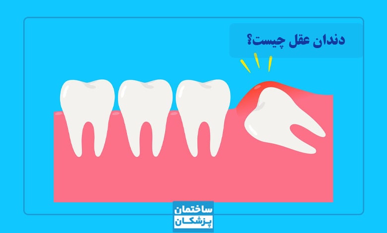 دندان عقل چیست؟ چرا باید آن را جراحی کنیم؟