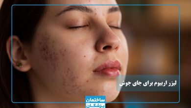 لیزر اربیوم برای جای جوش