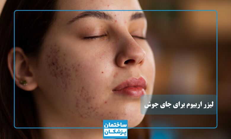 لیزر اربیوم برای جای جوش