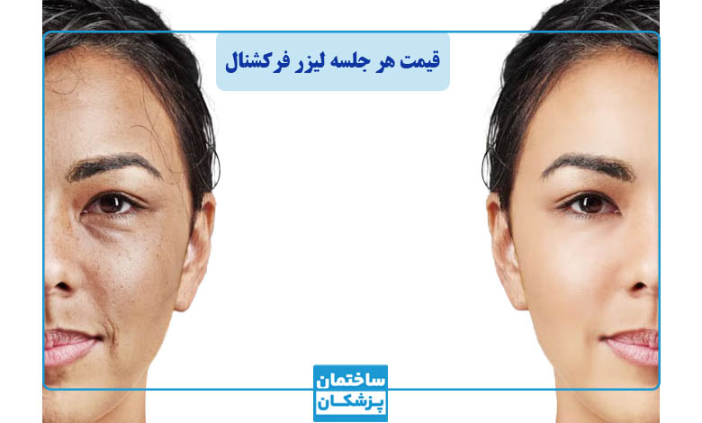 هزینه لیزر co2 فرکشنال در سال 1404