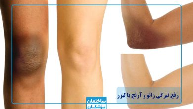 رفع تیرگی زانو و آرنج با لیزر