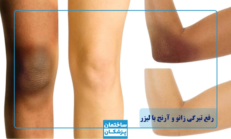 رفع تیرگی زانو و آرنج با لیزر