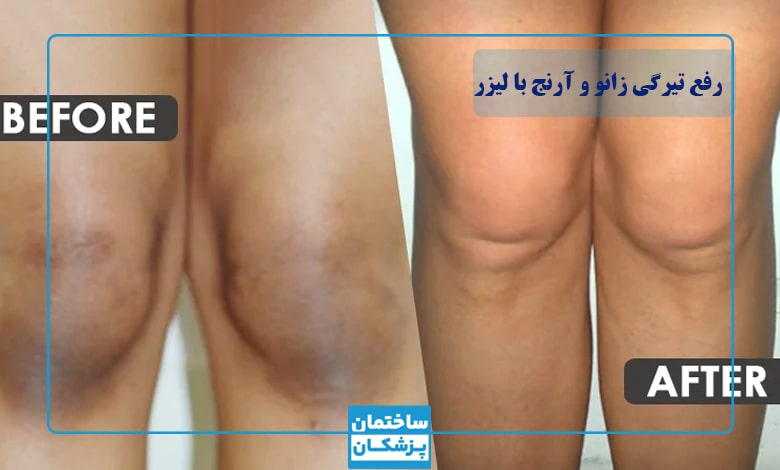 عکس قبل و بعد از رفع تیرگی زانو و آرنج با لیزر