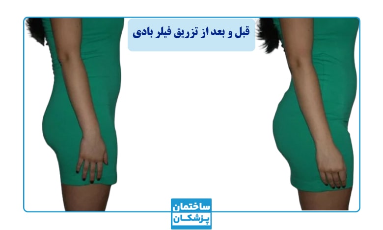 عکس قبل و بعد از تزریق فیلر بادی