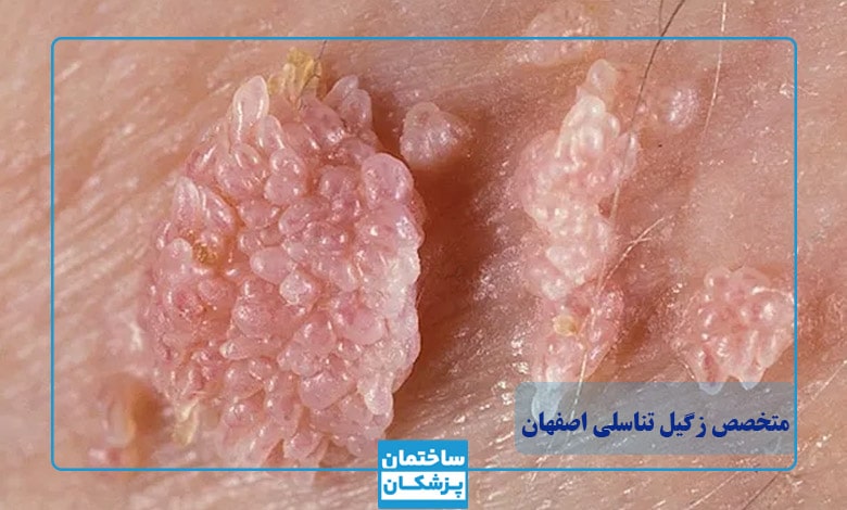 بهترین دکتر برای درمان زگیل تناسلی زنان در اصفهان