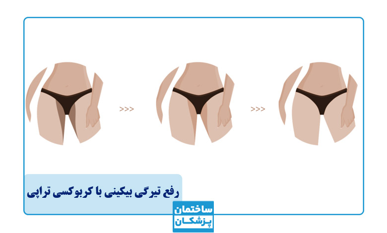 رفع تیرگی بیکینی با کربوکسی تراپی چیست؟