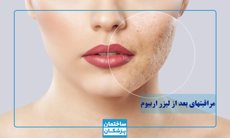 مراقبتهای بعد از لیزر اربیوم برای جای جوش
