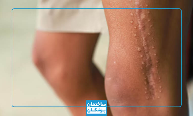مراقبتهای بعد از درمان اسکار