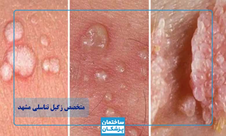 بهترین متخصص زگیل تناسلی در مشهد