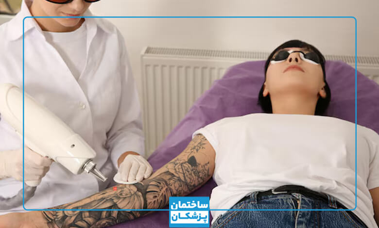 هزینه پاک کردن تاتو با روش های مختلف