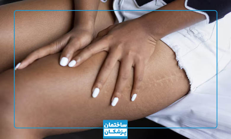 اسکار پوستی چیست