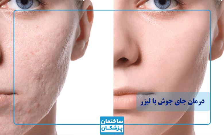 لیزر اربیوم چیست