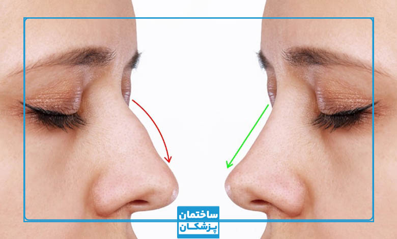 مراقبت های قبل و بعد از جراحی بینی در اصفهان