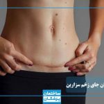بهترین روش درمان جای زخم سزارین چیست؟