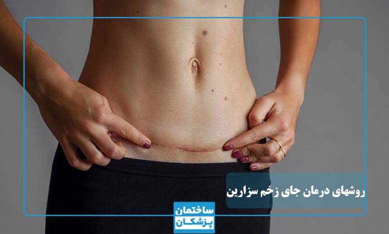 بهترین روش درمان جای زخم سزارین چیست؟