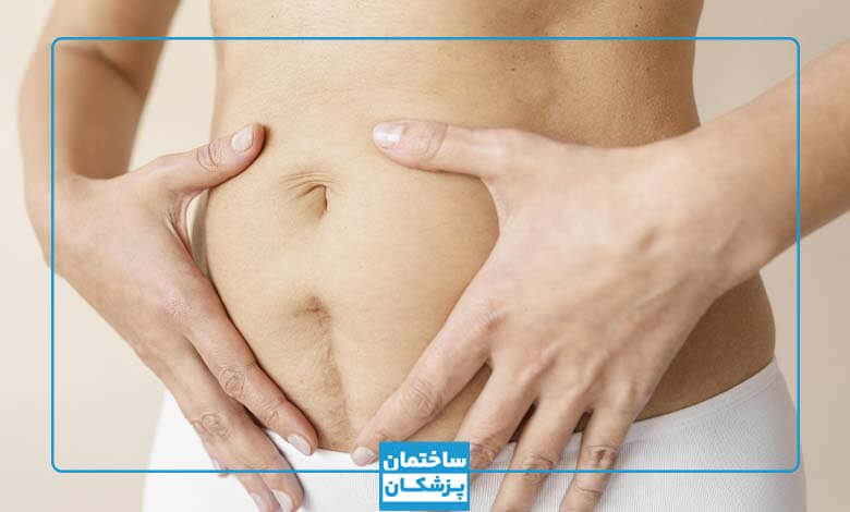 عکس جای زخم سزارین