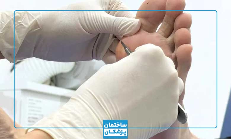 بهترین متخصص درمان میخچه در تهران