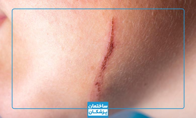 چگونه جای زخم روی صورت را از بین بریم؟