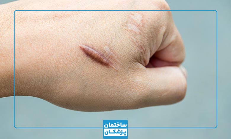 معرفی روشهای درمان و از بین بردن جای زخم