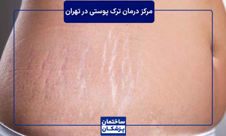 بهترین روش برای درمان ترک پوستی چیست؟