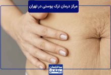 بهترین مرکز درمان ترک پوستی در تهران