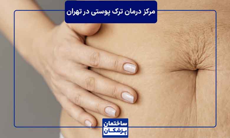 بهترین مرکز درمان ترک پوستی در تهران