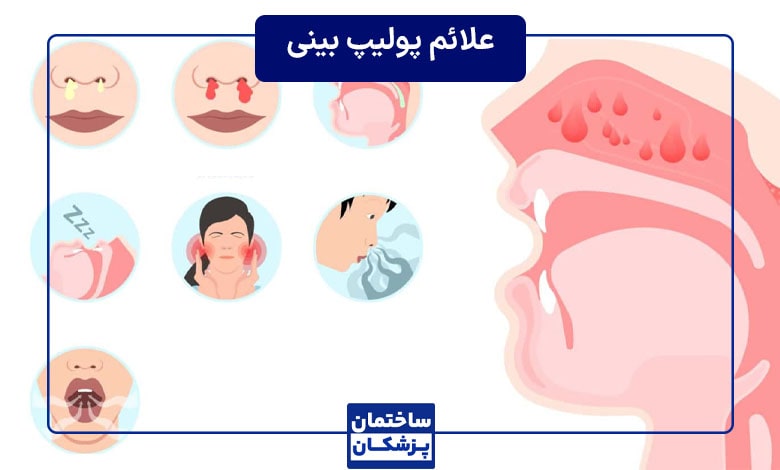 علائم و نشانه های پولیپ بینی