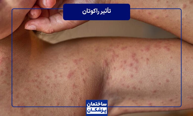 چه مدت بعد، تأثیر راکوتان را می‌بینیم؟