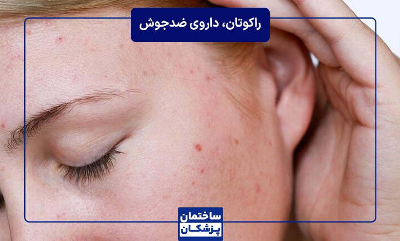 راکوتان، قویترین داروی ضدجوش
